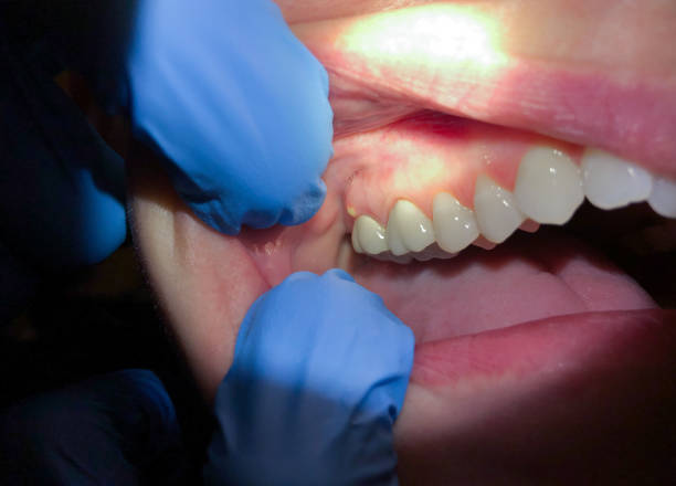 Best Emergency Dentist for Lost Fillings or Crowns in Ithaca, NY